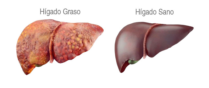 Hígado graso e Hígado sano